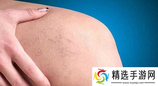 日系裸妆女士静脉曲张是什么得的