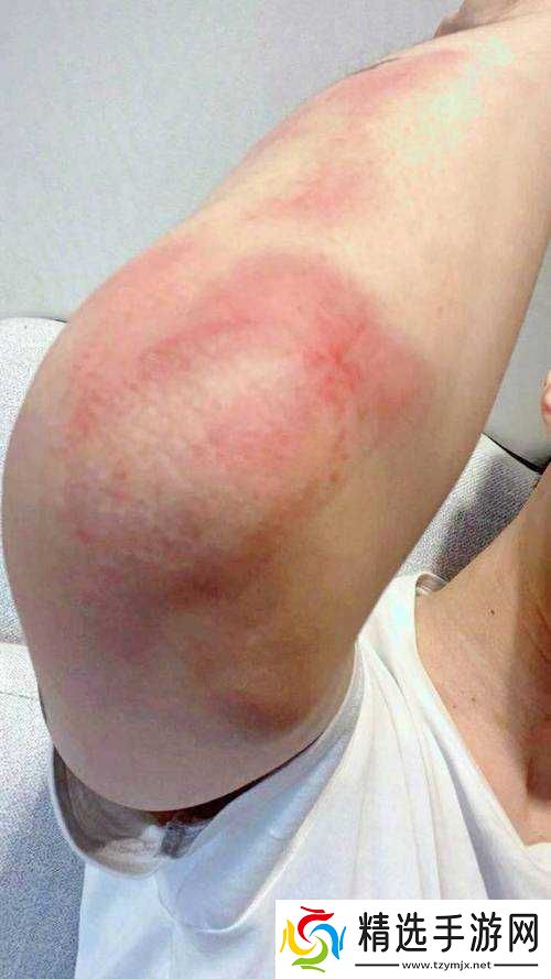 红肿疼痛小缝不能合拢